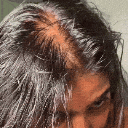 Hair Fall Isn't Rare Anymore
